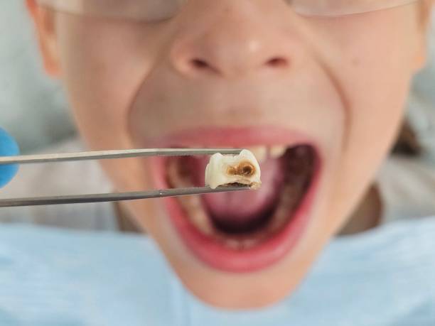 Best Emergency Tooth Extraction in Baltimore Highlands, MD